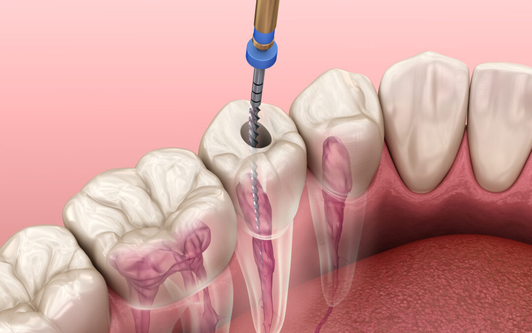 Why Root Canal Therapy is Essential for Saving Your Tooth